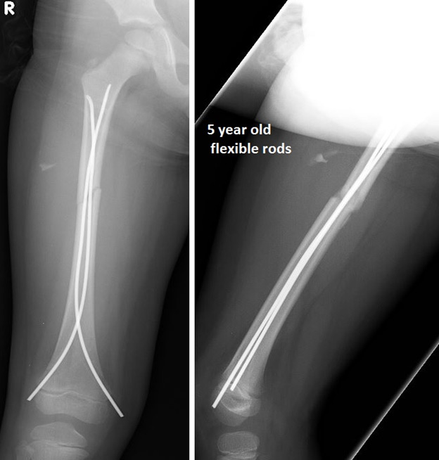 Femur Fracture xray