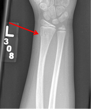 Buckle Fracture