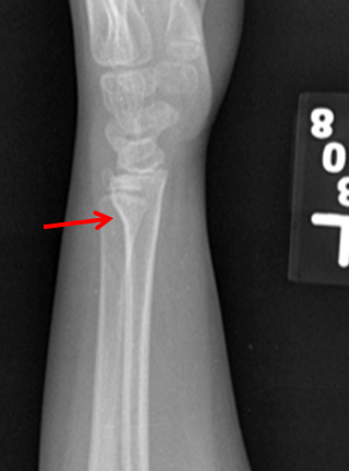 Buckle Fracture