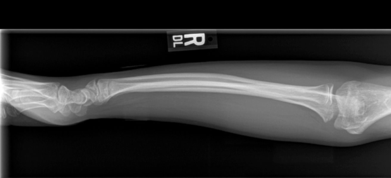 Figure: X-ray example of plastic deformation. The bones in the forearm are bowed but not broken.