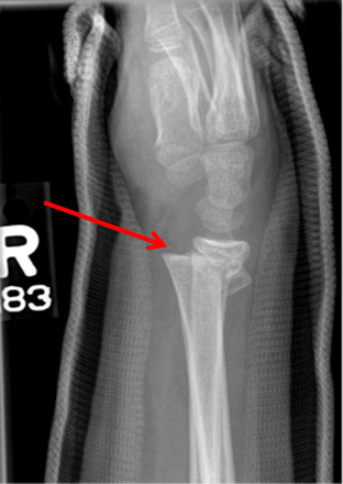 Growth Plate Fracture