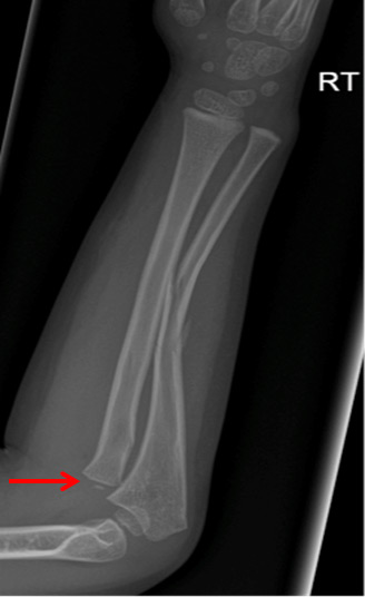 Monteggia Fracture