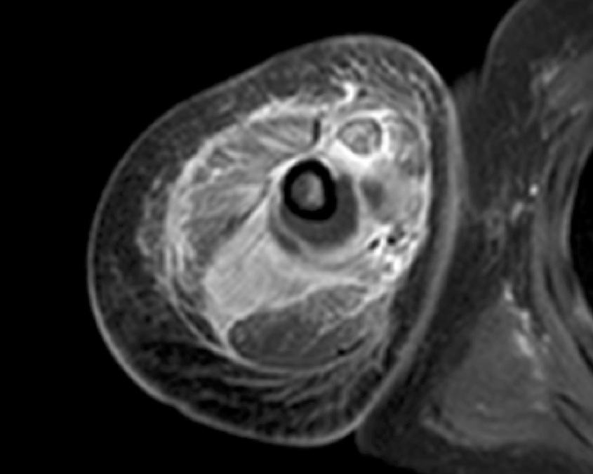 Infection on MRI