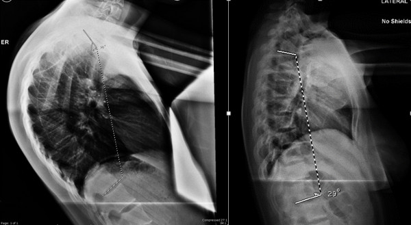 Scheurmann’s Kyphosis xray