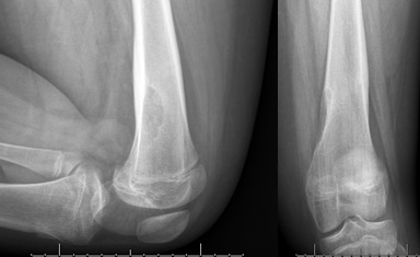 Non-ossifying Fibroma