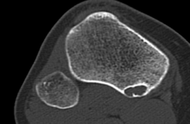 Non-ossifying Fibroma