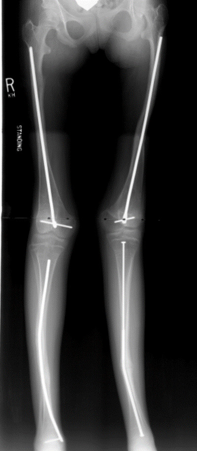 Osteogenesis Imperfecta Xray