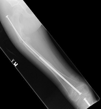 Osteogenesis Imperfecta