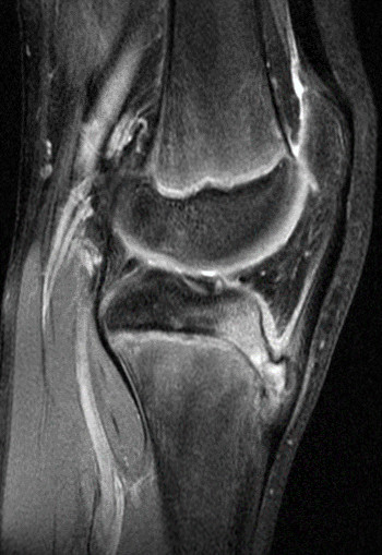 MRI Osgood Schlatter