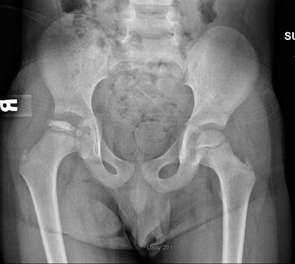 Perthes Xray