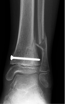 Physeal Fractures