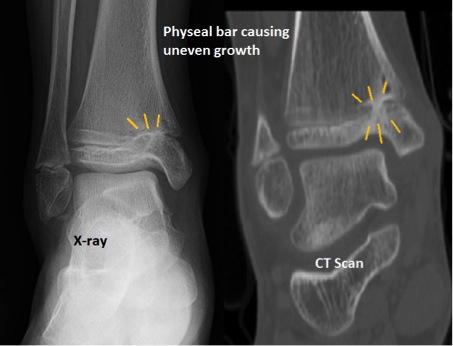 Physeal Bar