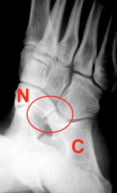 Calcaneonavicular Coalition 