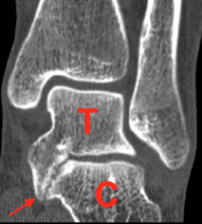 Talocalcaneal Coalition