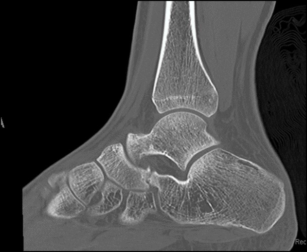 calcaneonavicular coalition