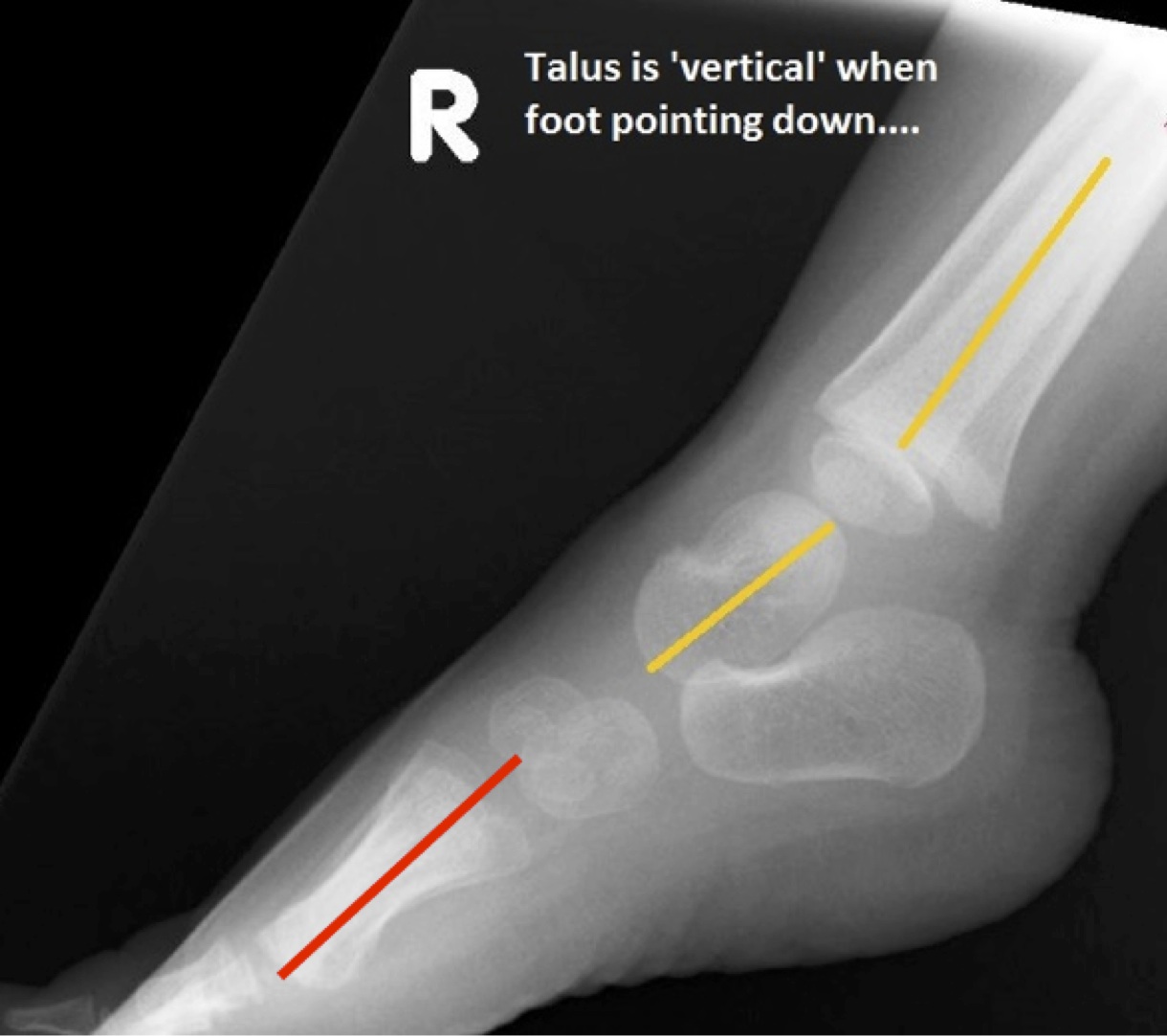 Vertical Talus Platarflexion