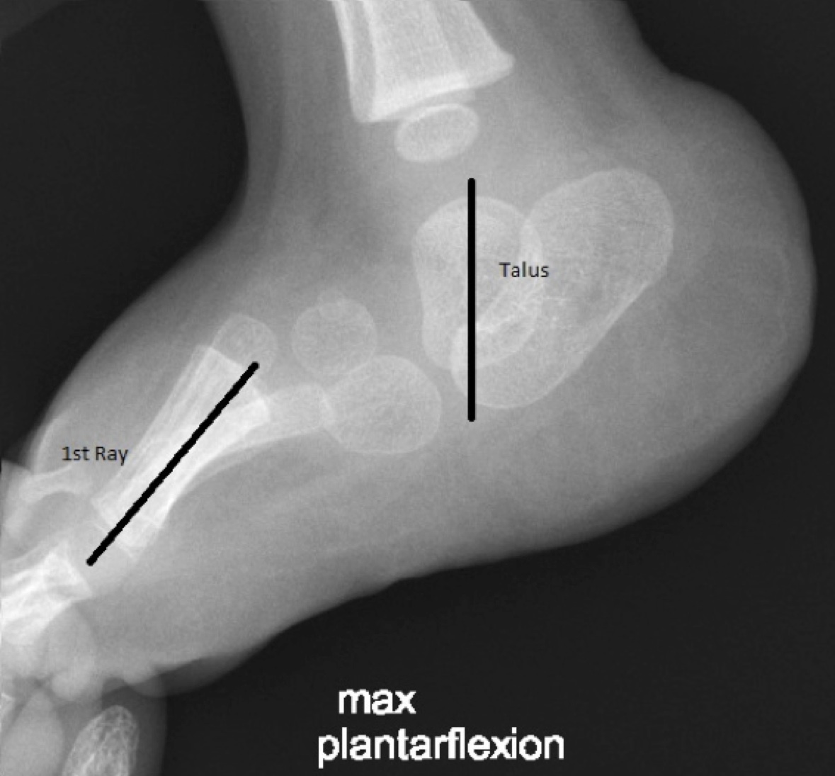 Vertical Talus Xray