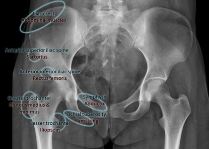 Figure-3-X-ray-of-avulsion-fracture-sites.png